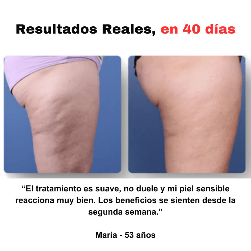 CelluStop™ – Masajeador Anticelulitis