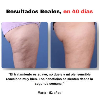 CelluStop™ – Masajeador Anticelulitis
